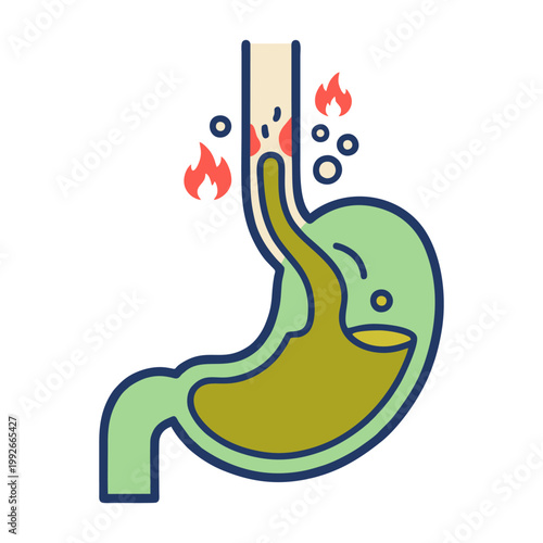 GERD Acid Reflux and Stomach Heartburn Medical Illustration
