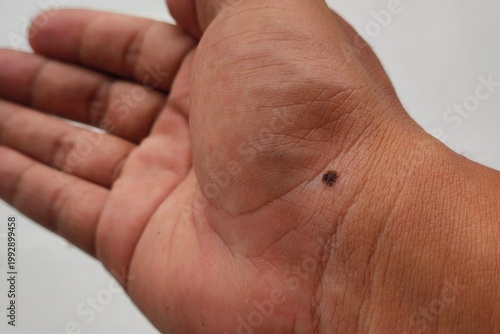 Close-up of dark mole on human palm wrist skin