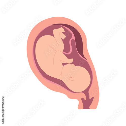 Placental Abruption Pregnancy Complication Childbirth Medical Illustration