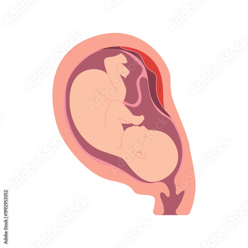 Placental Abruption Pregnancy Complication Childbirth Medical Illustration