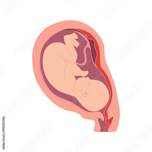 Placental Abruption Pregnancy Complication Childbirth Medical Illustration