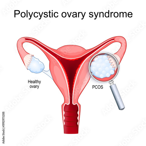 Polycystic ovary syndrome. Healthy ovary, PCOS, uterus and Magnifying glass