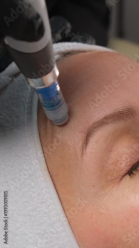 Professional cosmetologist performing a fractional mesotherapy facial treatment on a female client