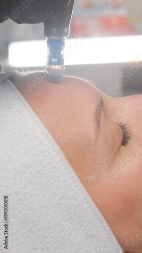 Cosmetologist performing a microneedling treatment on a female client's forehead in a beauty clinic