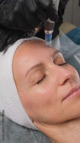 Beautician performing fractional mesotherapy microneedling on a woman's forehead in a beauty clinic