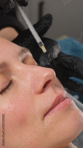 Aesthetic medicine professional injecting hyaluronic acid filler into a woman's nasolabial folds
