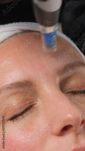 Close-up of a beautician performing a microneedling procedure on a woman's face