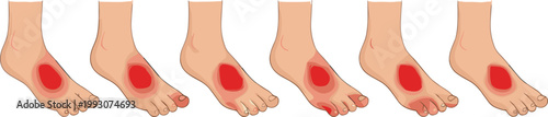 Foot pain and inflammation illustration set showing different affected areas, medical concept for injury, podiatry, healthcare and anatomy in flat vector style