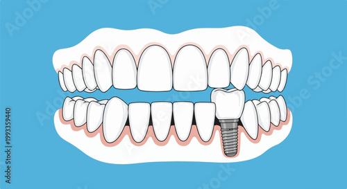 Illustration of a human dental implant replacing a missing tooth