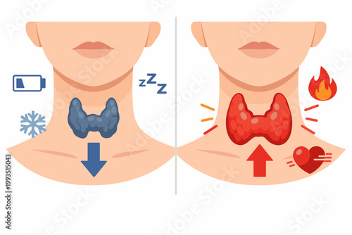 Medical Illustration Comparing Hypothyroidism and Hyperthyroidism Symptoms in the Human Thyroid Gland, Featuring Icons for Fatigue, Cold Sensitivity, Heat Intolerance, and Tachycardia in Flat Vector