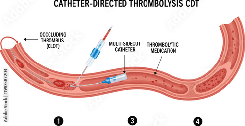 Catheter Directed Thrombolysis Medical Vector Illustration Showing Blood Clot Removal Procedure with Catheter and Thrombolytic Medication in Artery for Healthcare Design