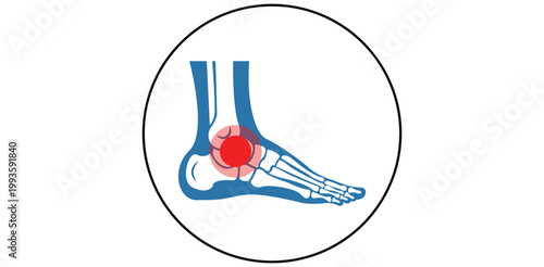 An illustration of a human foot with a red spot indicating pain or inflammation in the ankle area.