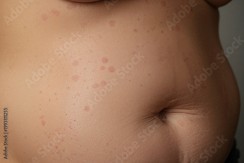 Abdomen skin showing dermatitis rash with pityriasis rosea