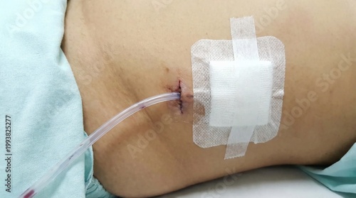 Medical IV infusion on human abdomen.