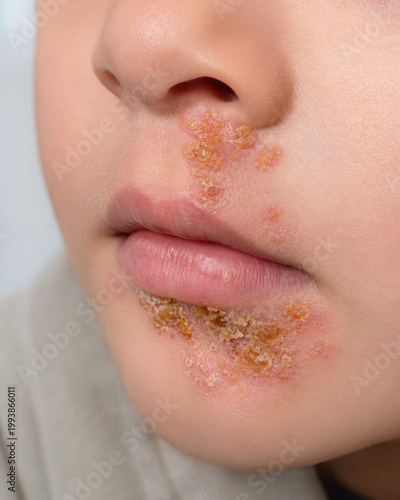 Impetigo with Honey Colored Crust on Child Face