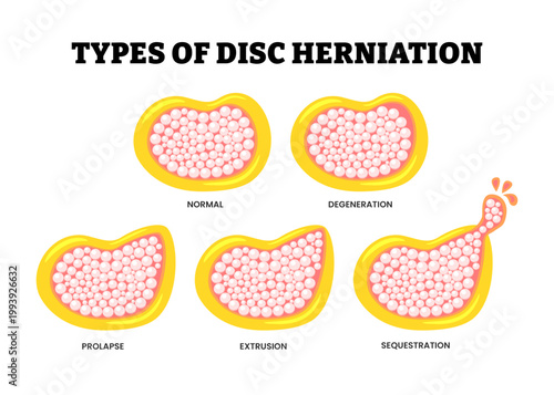 Different types of spinal disc herniation types set collection. Labeled normal, degeneration, prolapse, extrusion and sequestration. Spine disk stages of herniation vector illustration.