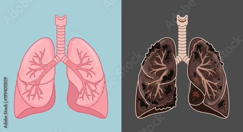 Healthy vs Smoker Lungs Comparison Flat Vector Illustration