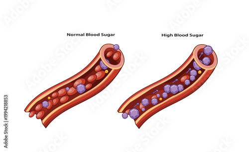 Normal vs High Blood Sugar in Artery Illustration