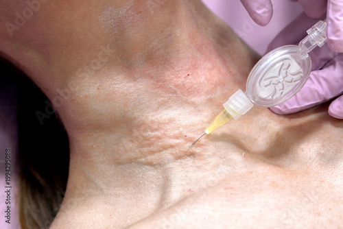 Experienced doctor carefully uses sterile methods for neck beautification injection