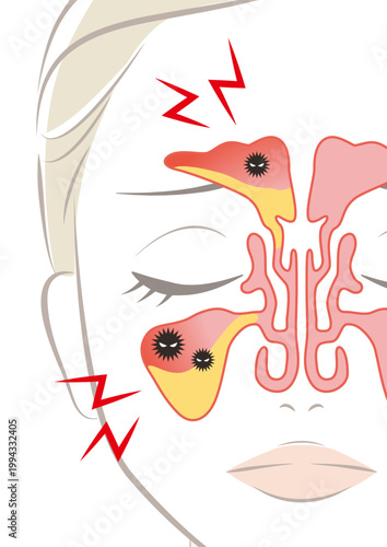 副鼻腔炎の鼻腔