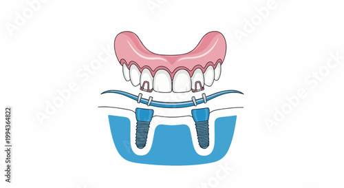 Dental implants support a denture, showing bone integration and attachment