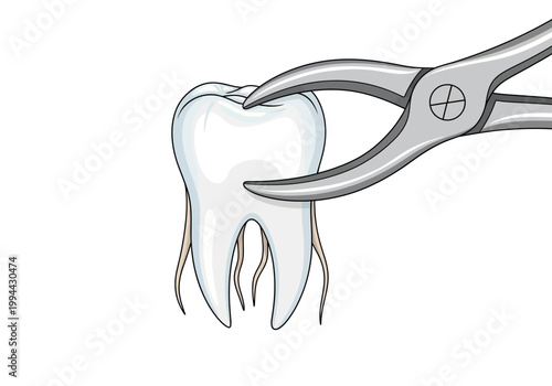 Dental extraction procedure with forceps on molar tooth in clinic