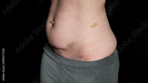 Fresh medical scars on female abdomen after laparoscopic surgery. Stretch marks on light caucasian skin after cesarean section on dark background. Body Lymphatic edema. Maternity concept. Front view.