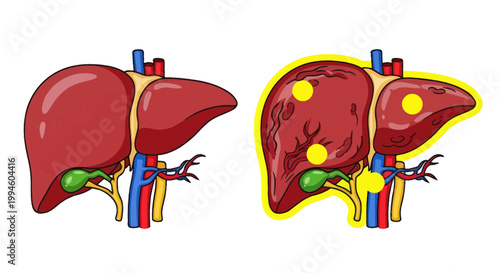 Human Liver Anatomy Comparison: Healthy vs. Affected