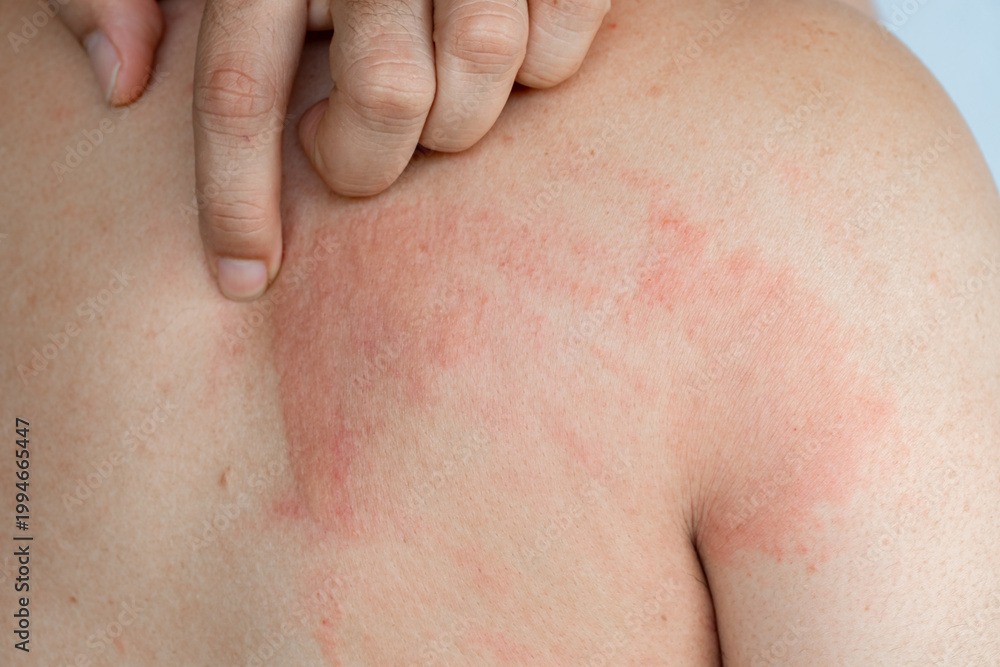 Naklejka premium Close up of a man with a red skin rash and inflammation on his back. A person scratching an itchy allergic reaction, eczema, or dermatitis on the body. Concept of healthcare and dermatology, urticaria