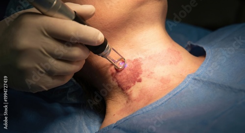 Laser treatment for port-wine stain birthmark on neck