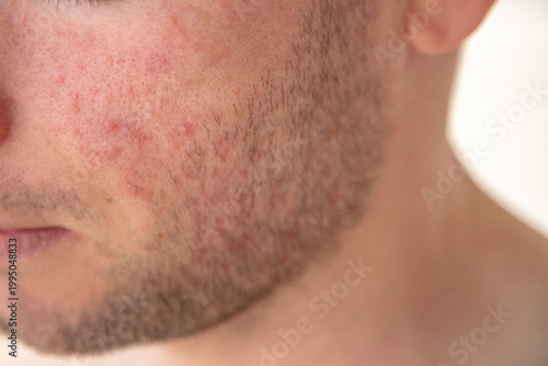 Fotografie Facial skin redness and irritation on a young man’s cheek, suggesting inflammation or dermatitis in a close-up dermatology concept