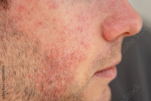 Billede på lærred Facial skin redness and irritation on a young man’s cheek, suggesting inflammation or dermatitis in a close-up dermatology concept