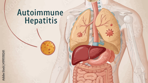 Autoimmune hepatitis concept with human body and liver illustration
