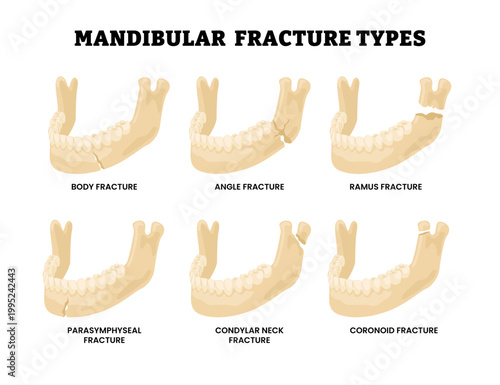 Different types of mandibular fracture types. Labeled body angle ramus parasymphyseal condylar neck and coronoid fracture diagram hand drawn schematic. Medical science illustration poster.