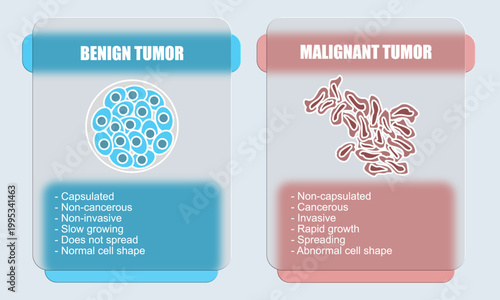Vector illustration of malignant and benign tumors in body tissues. Difference between malignant and benign tumors, Spread of cancer cells. Glass effect design for education, posters, clinics,