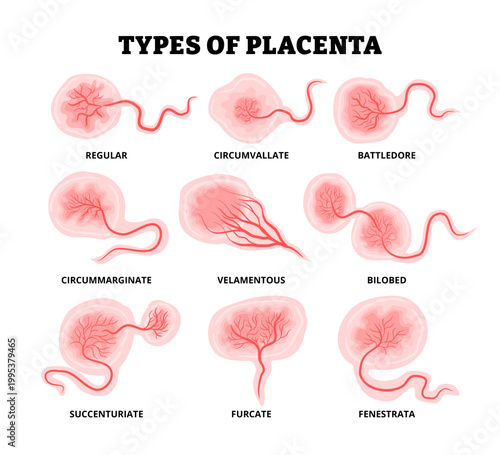 Different types of placenta variations types. Labeled reguler, circumvallate battledore circummarginate velamentous bilobed succenturiate furcate fenestrata.  Flat vector medical illustration.