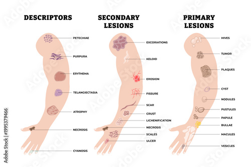 Different types of skin disease types. Labeled descriptors and lesions. Skin assessment poster diagram illustration with hives, tumor, plaques, cyst, nodules, pustules, papule, bullae, macules, etc.