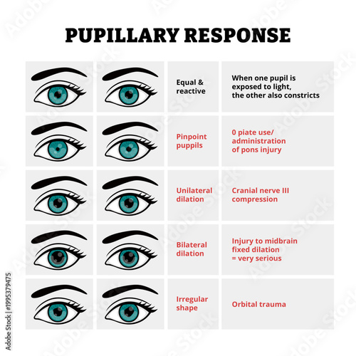 Different types of abnormal pupillary response or reflex types. Labeled equal and reactive, pinpoint pupils, unilateral bilateral dilation, irregular shapes. Medical illustration poster design.
