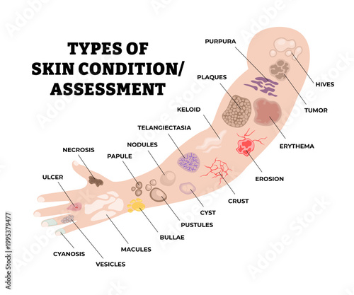 Different types of skin disease types. Labeled descriptors and lesions. Skin assessment poster diagram illustration with hives, tumor, plaques, cyst, nodules, pustules, papule, bullae, macules, etc.