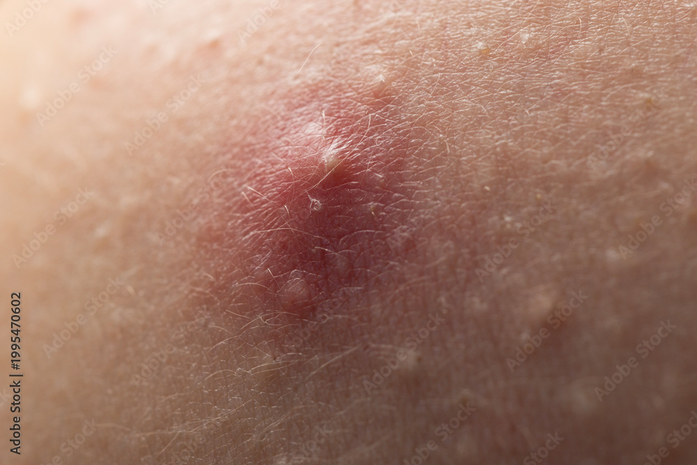 Fototapeta premium Acne skin pimple. Skin problem with pimple bumps. Irritated pimple texture. Close up pimple issue.