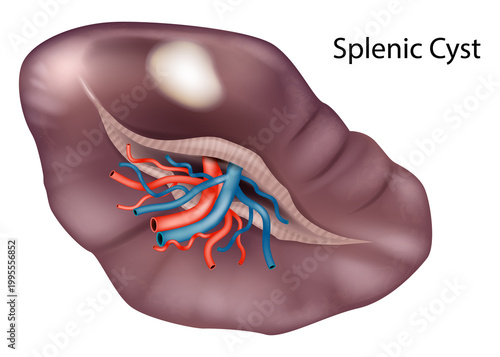 Splenic Cyst Medical Illustration Human Spleen Anatomy Cross Section Vascular Structure. Splenic Cyst Pathology Diagram 