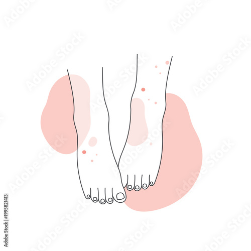 Human legs with skin allergy. Feet covered with red rash, atopic dermatitis line vector illustration