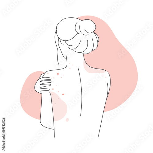 Back view of woman body with allergic skin reaction. Female body covered with red rash line vector illustration