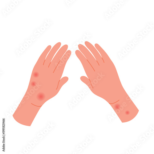 Human hands covered with red rash. Allergic itchy reaction, atopic dermatitis flat vector illustration