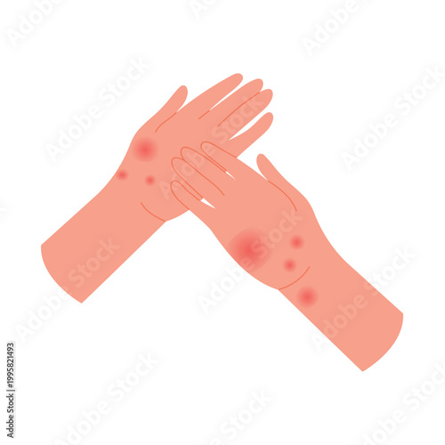 Human hands with allergic reaction. Hands covered with red itchy rash flat vector illustration