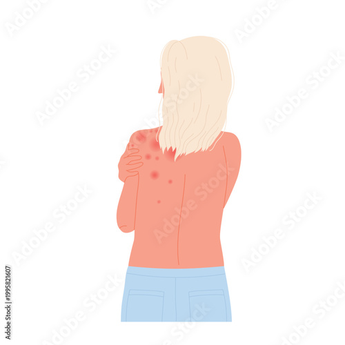 Back view of girl with body allergy. Allergic itchy reaction, atopic dermatitis flat vector illustration