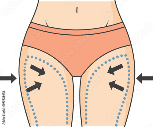 Body Contouring Illustration: Depicting a person's thighs and hips, with dotted outlines indicating areas for contouring and arrows suggesting directional forces.
