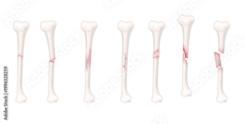 bones structure broken bones
