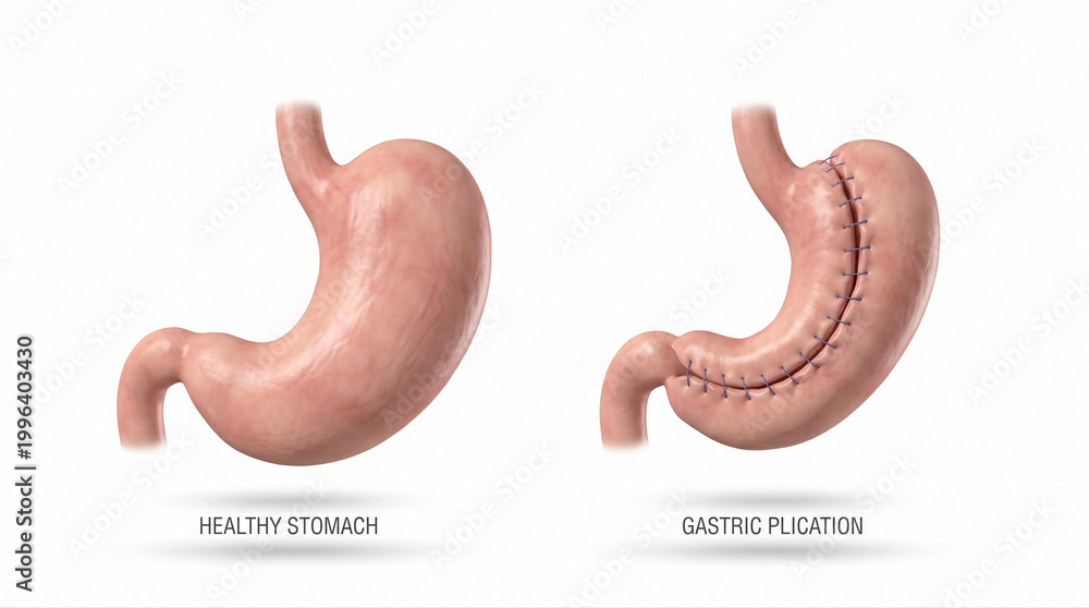 Fototapeta premium Gastric Plication Surgery for Weight Loss Treatment