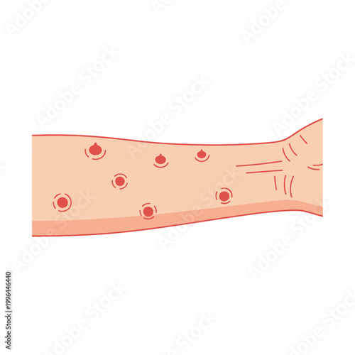 Vector Illustration of Skin Rash and Red Inflamed Bumps on a Human Arm for Dermatology and Medical Educational Content